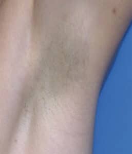 Laser Hair Removal